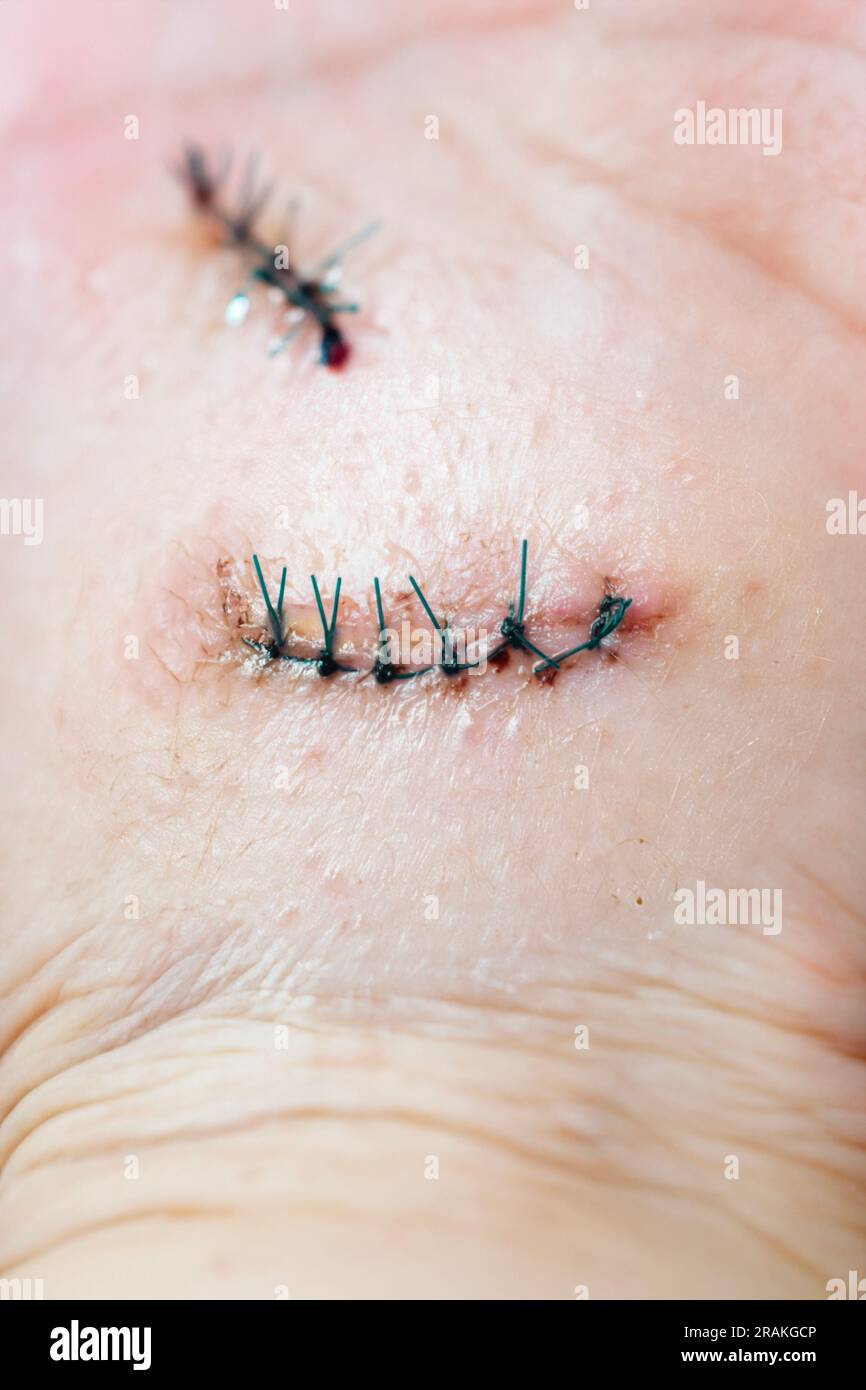 Medical stitches hi-res stock photography and images - Alamy