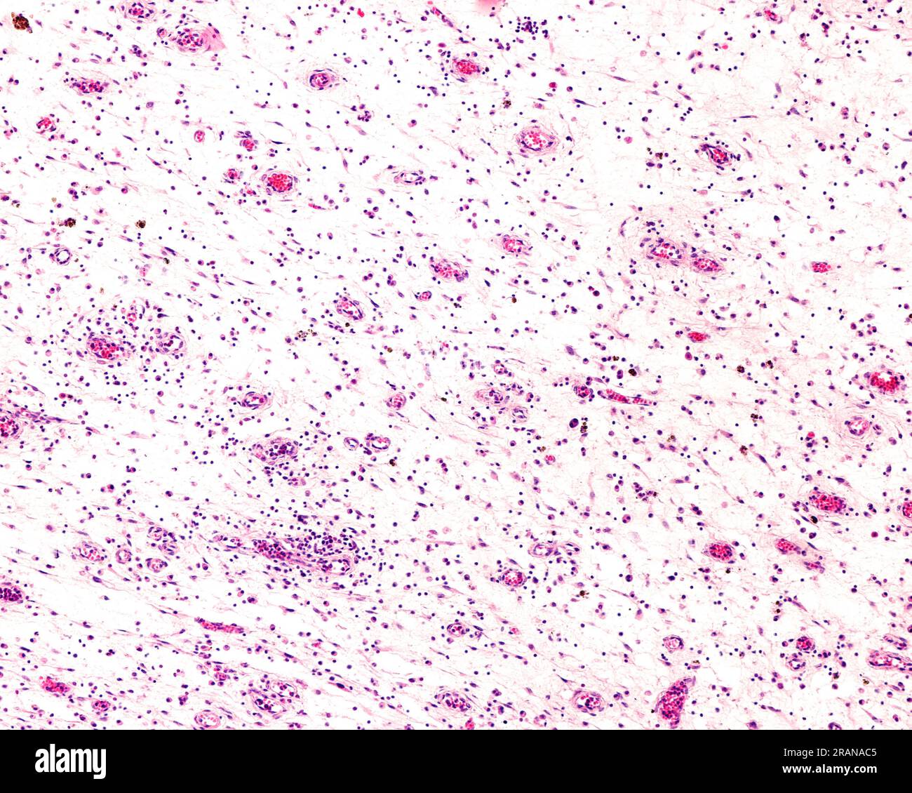 Chronic inflammation in connective tissue, light micrograph Stock Photo ...
