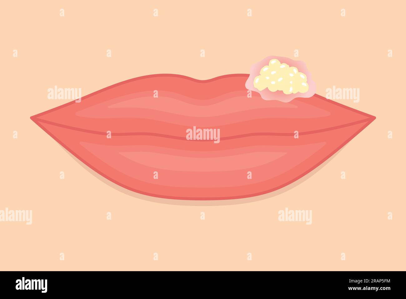 female lips infected with herpes virus- vector illustration Stock Vector