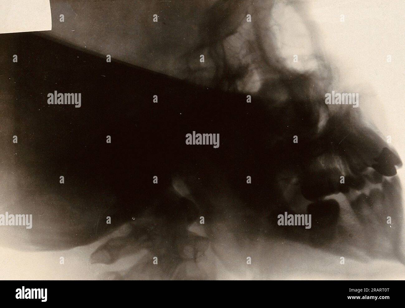 A fractured jaw xray. Photograph, 1914/1918. Lettering Simple