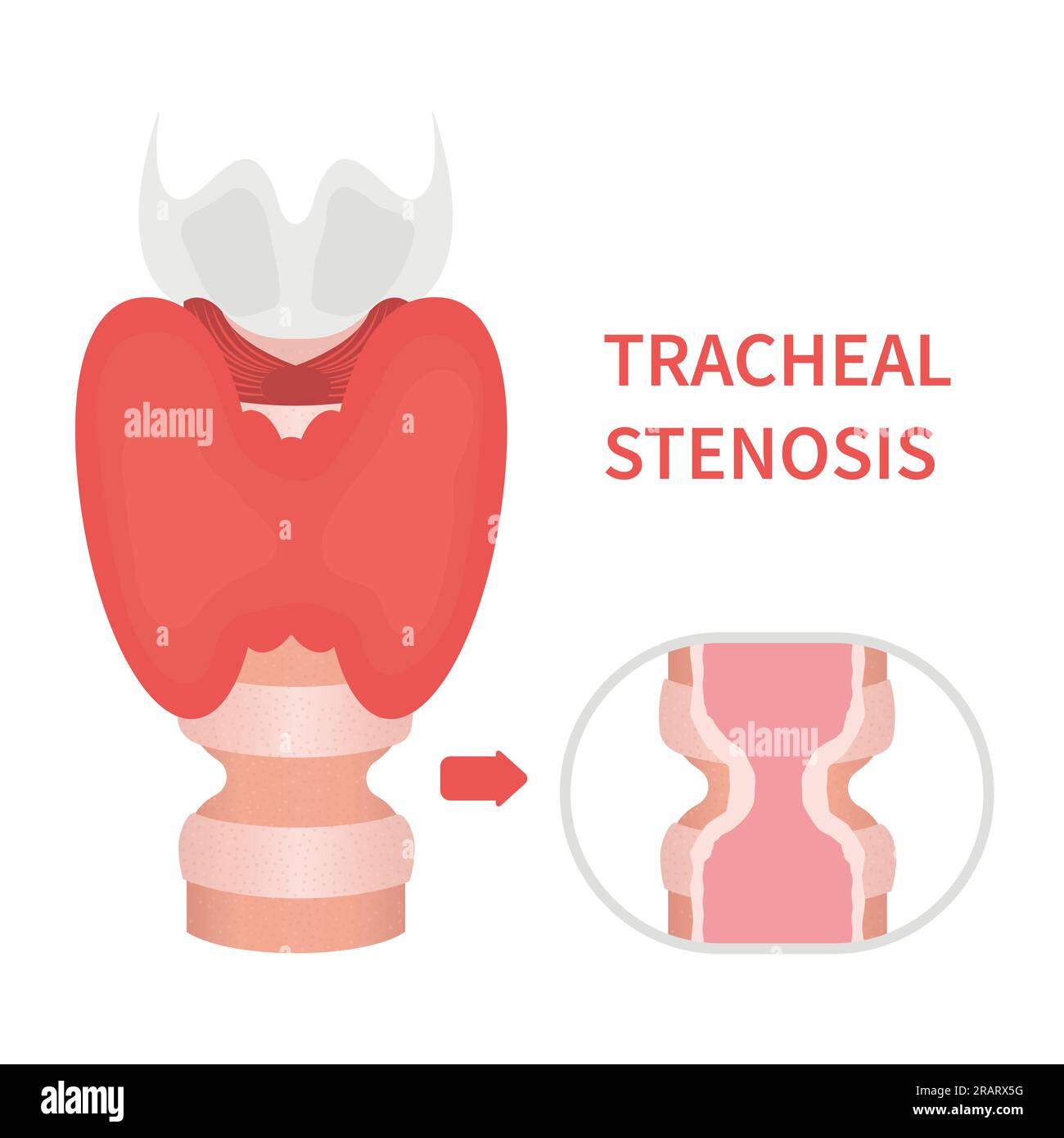 Trachea narrowing awareness icon of tracheal stenosis Stock Vector