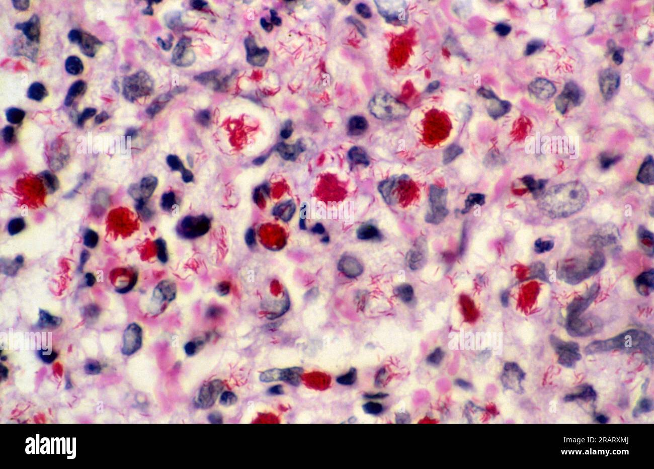 Leprosy skin section. Description Lepromatous leprosy (LL) skinThis