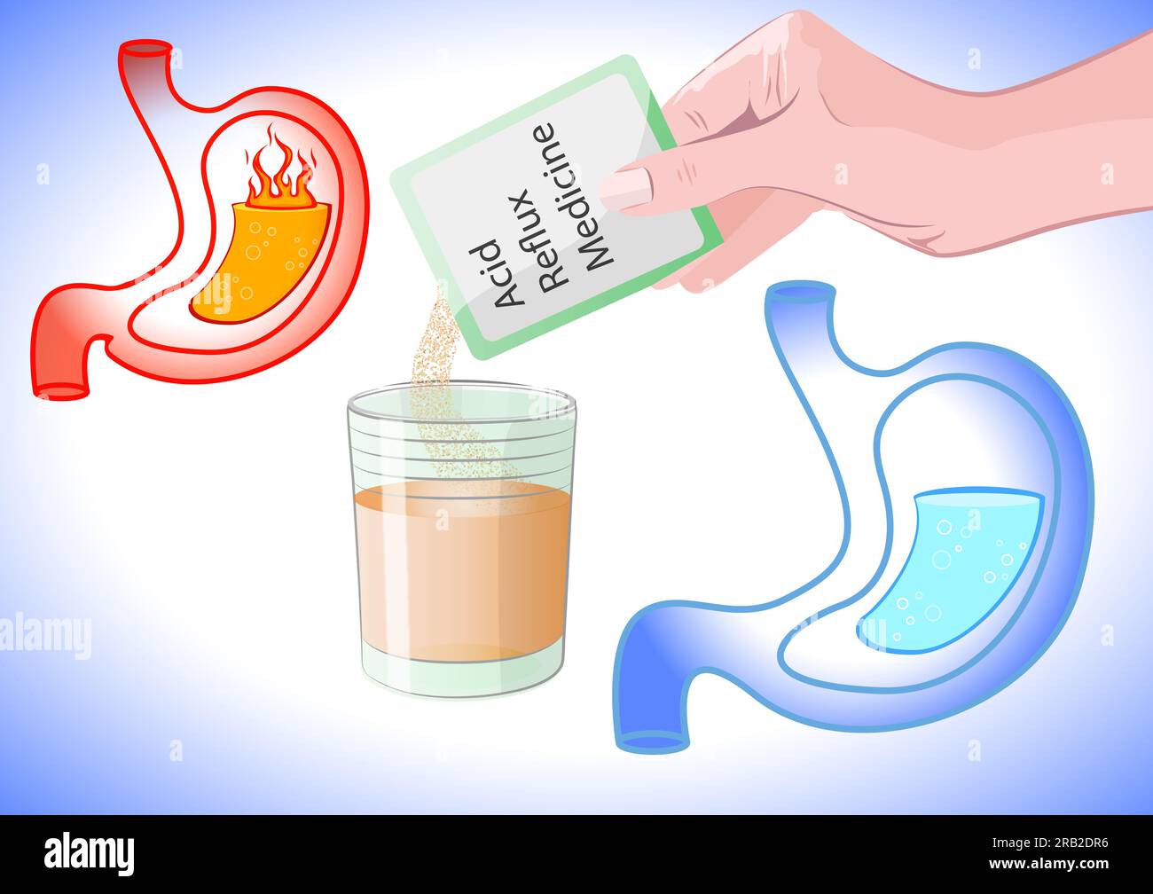 Heartburn treatment. Woman pouring acid reflux medicine into glass on light background, closeup. Illustrations of stomachs with lava as acid indigesti Stock Photo