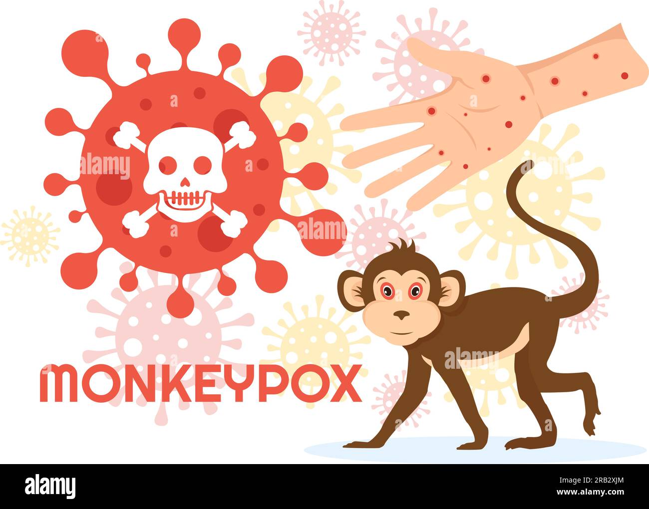 Monkey Pox Outbreak Vector Illustration of Virus Symptoms in Humans