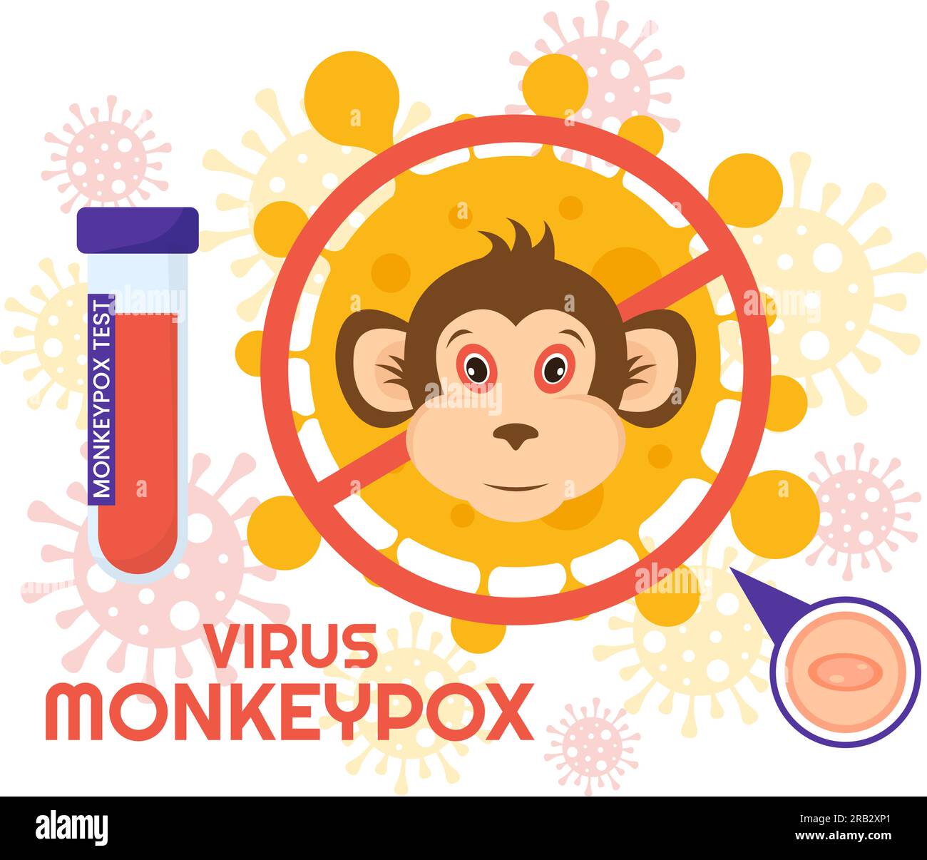 Monkey Pox Outbreak Vector Illustration of Virus Symptoms in Humans
