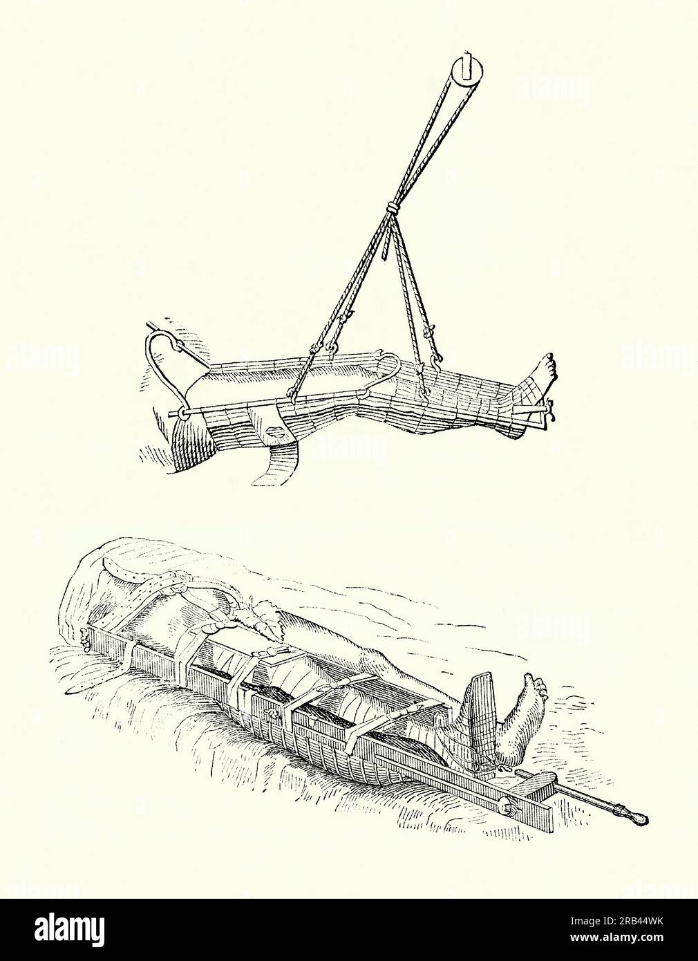 An old engraving of the use of splints for a leg fracture in the 1800s. It is from a Victorian mechanical engineering book of the 1880s. Ropes and pulleys, plus a steel and mesh cage, keep are used to elevate the injured leg (top), while wooden splints each side of the leg, with straps between the two, keep it totally immobilised (bottom). Stock Photo
