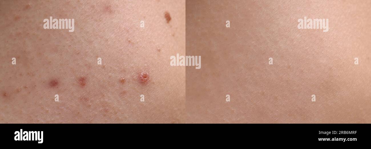 Acne can affect more than your skin - American Academy of Dermatology