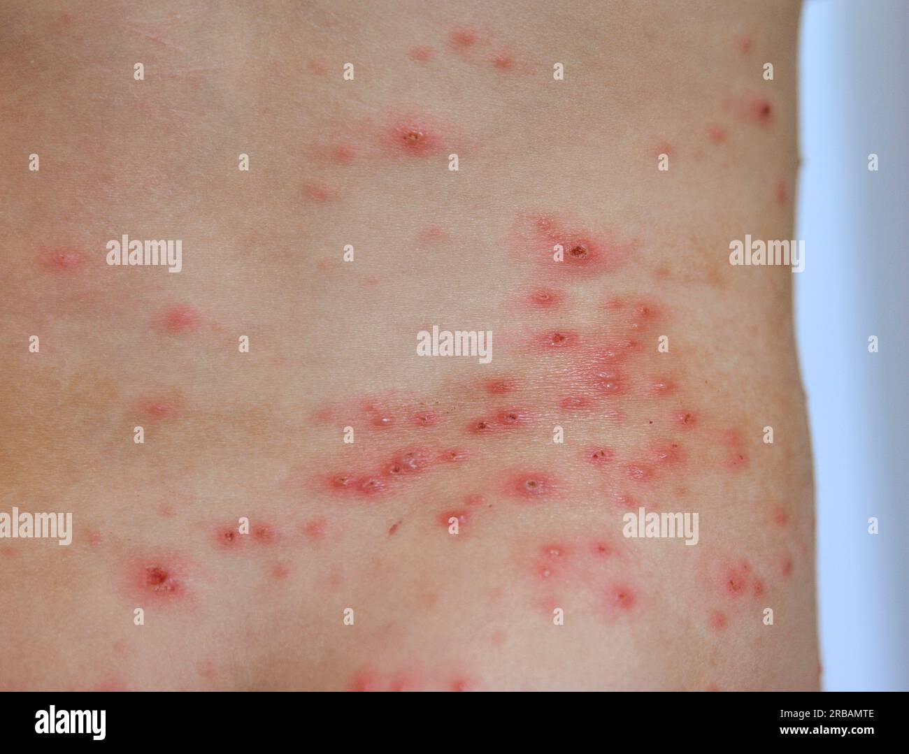 Closeup of Chicken pox rash Viral infections disease Stock Photo Alamy