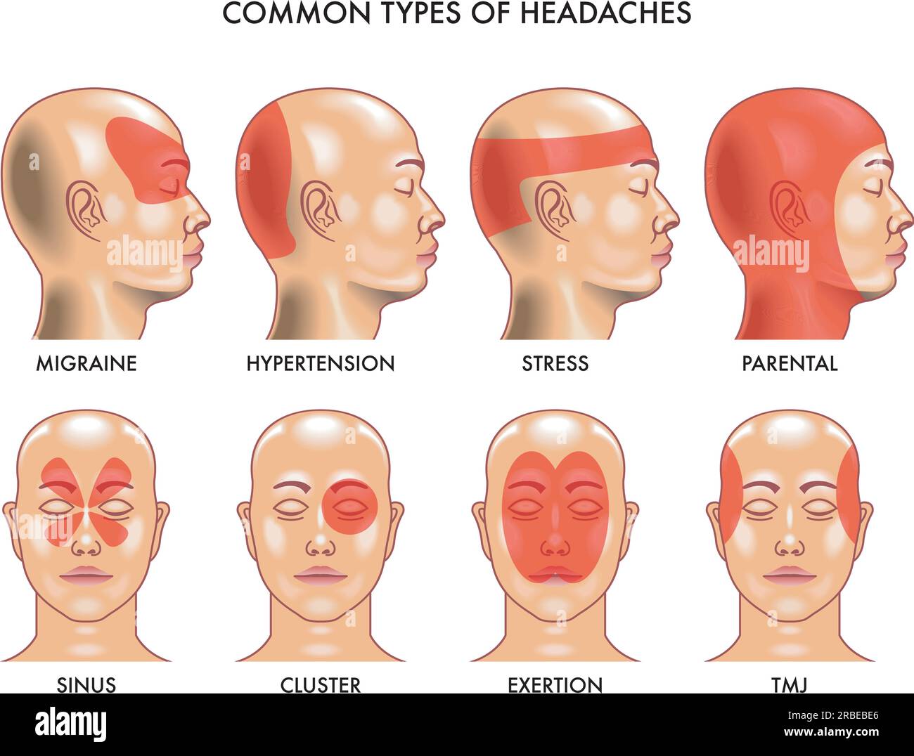 Medical Illustration of common types of headaches. Stock Vector