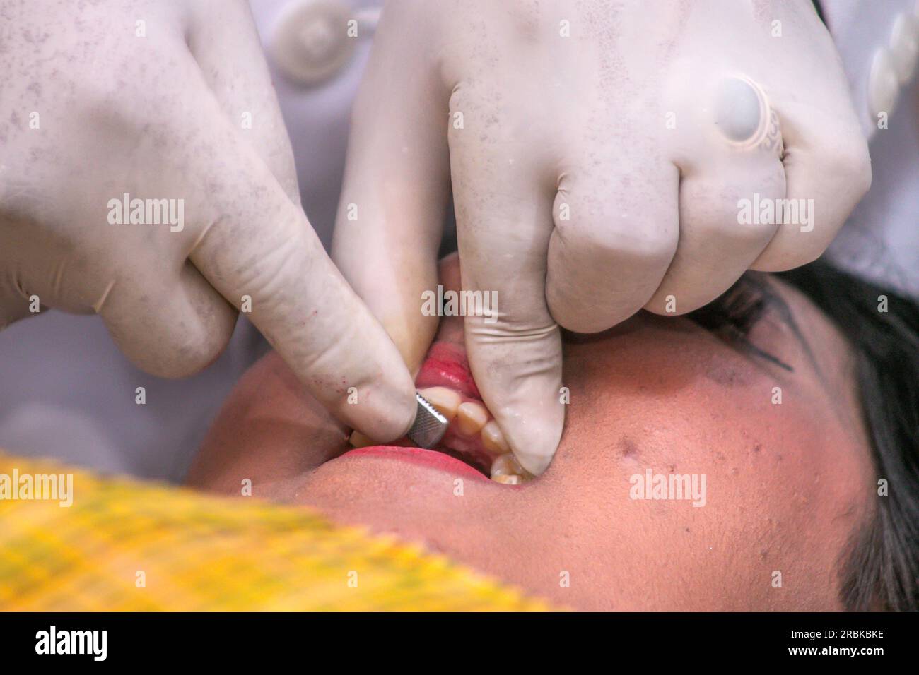 Filing Cutter Teeth Dentists file the teeth in the tooth-cutting procession at the Giri ...