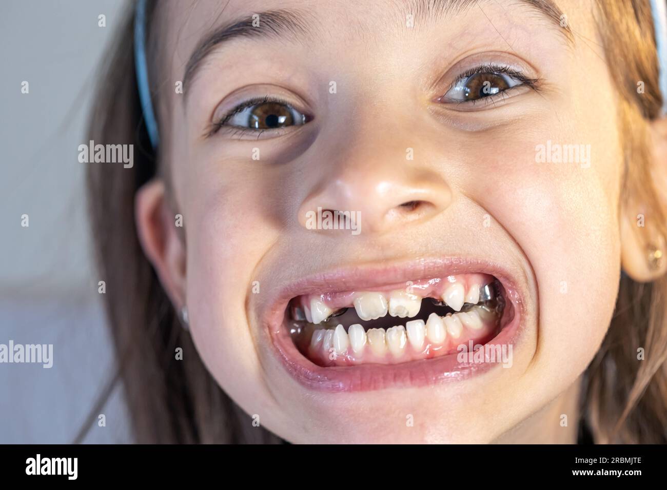 Lingual frenulum child hi-res stock photography and images - Alamy