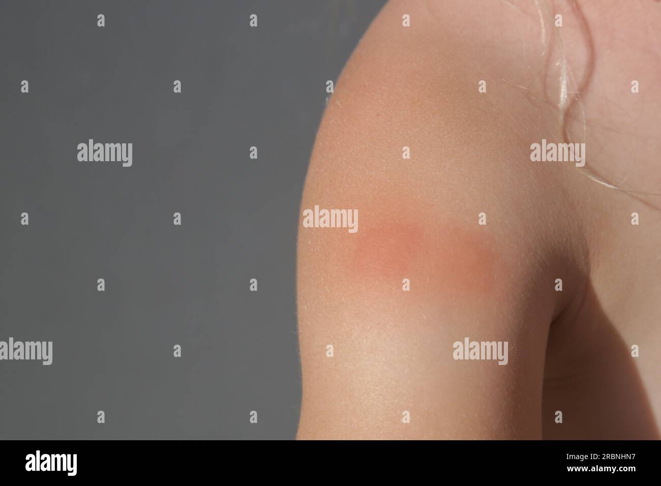 Little girl has skin rash from allergy or mosquito bites Stock Photo