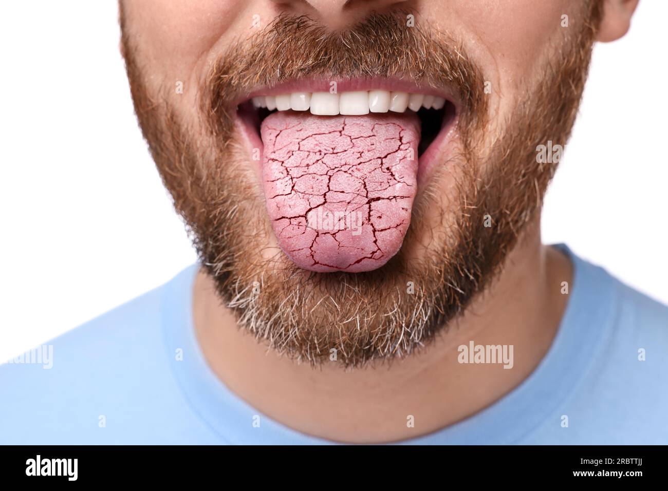 Dry mouth symptom. Man showing dehydrated tongue on white background