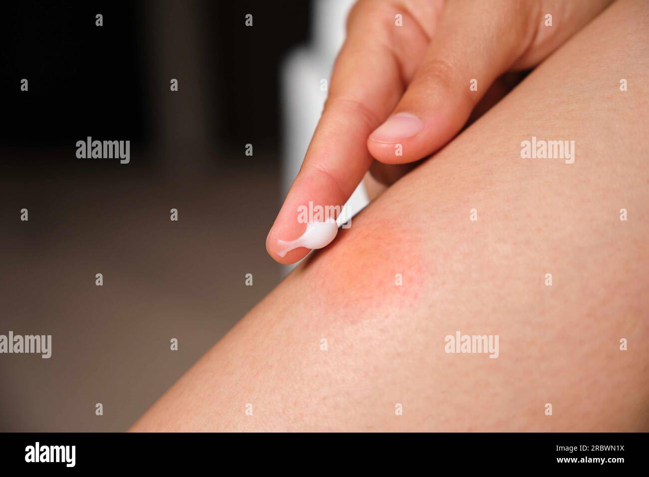 Woman applying medicine cream on mosquito bite on her leg. Stock Photo