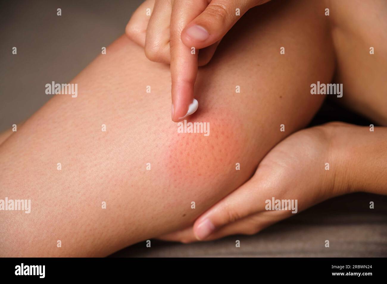 Woman applying medicine cream on mosquito bite on her leg. Stock Photo