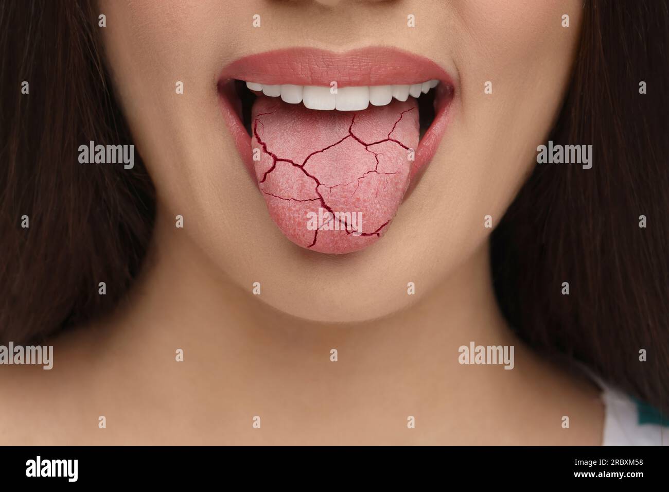 Dry mouth symptom. Woman showing dehydrated tongue, closeup Stock Photo