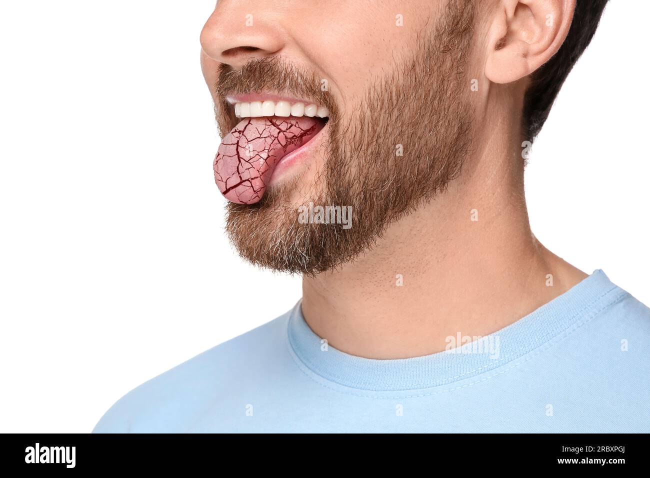Dry mouth symptom. Man showing dehydrated tongue on white background