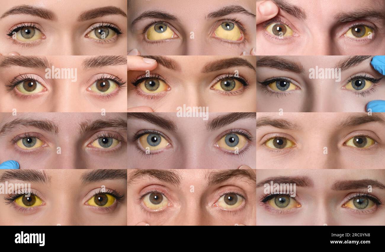Yellowing of eyes as symptom of hepatitis. Collage with photos of