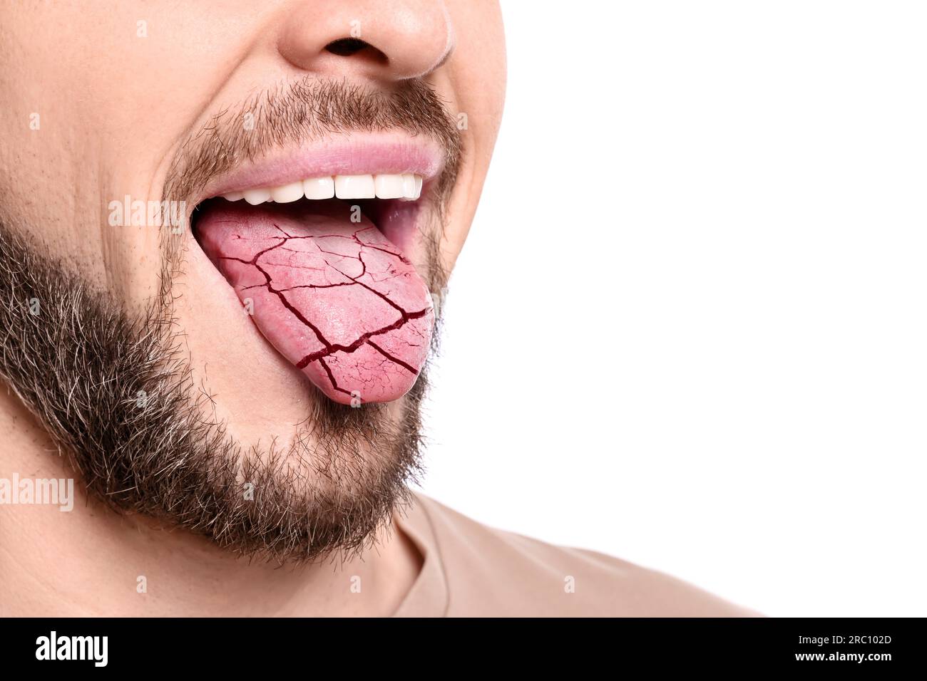 Dry mouth symptom. Man showing dehydrated tongue on white background