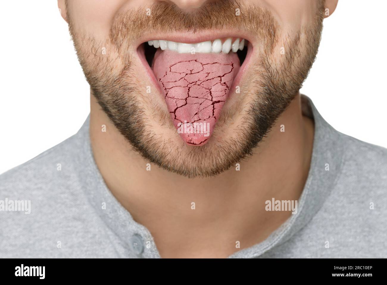 Dry mouth symptom. Man showing dehydrated tongue on white background