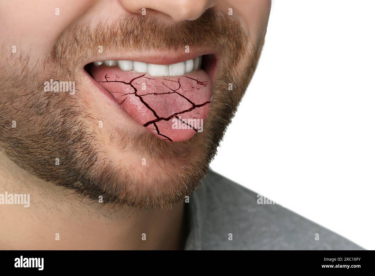 Dry mouth symptom. Man showing dehydrated tongue on white background