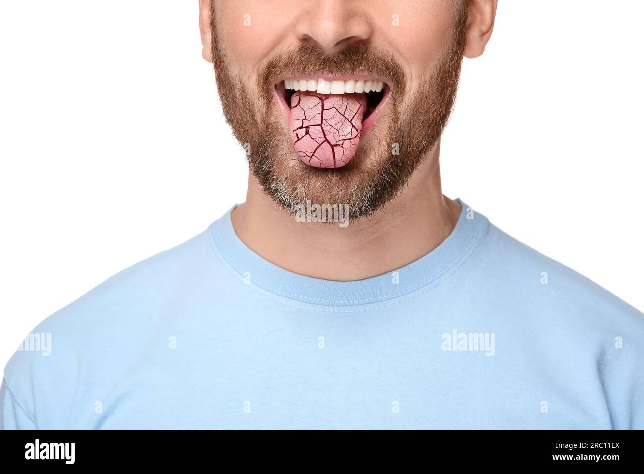 Dry mouth symptom. Man showing dehydrated tongue on white background