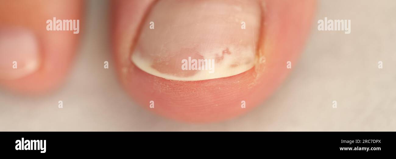 Close up view of damaged toenail, shallow depth of field. Stock Photo