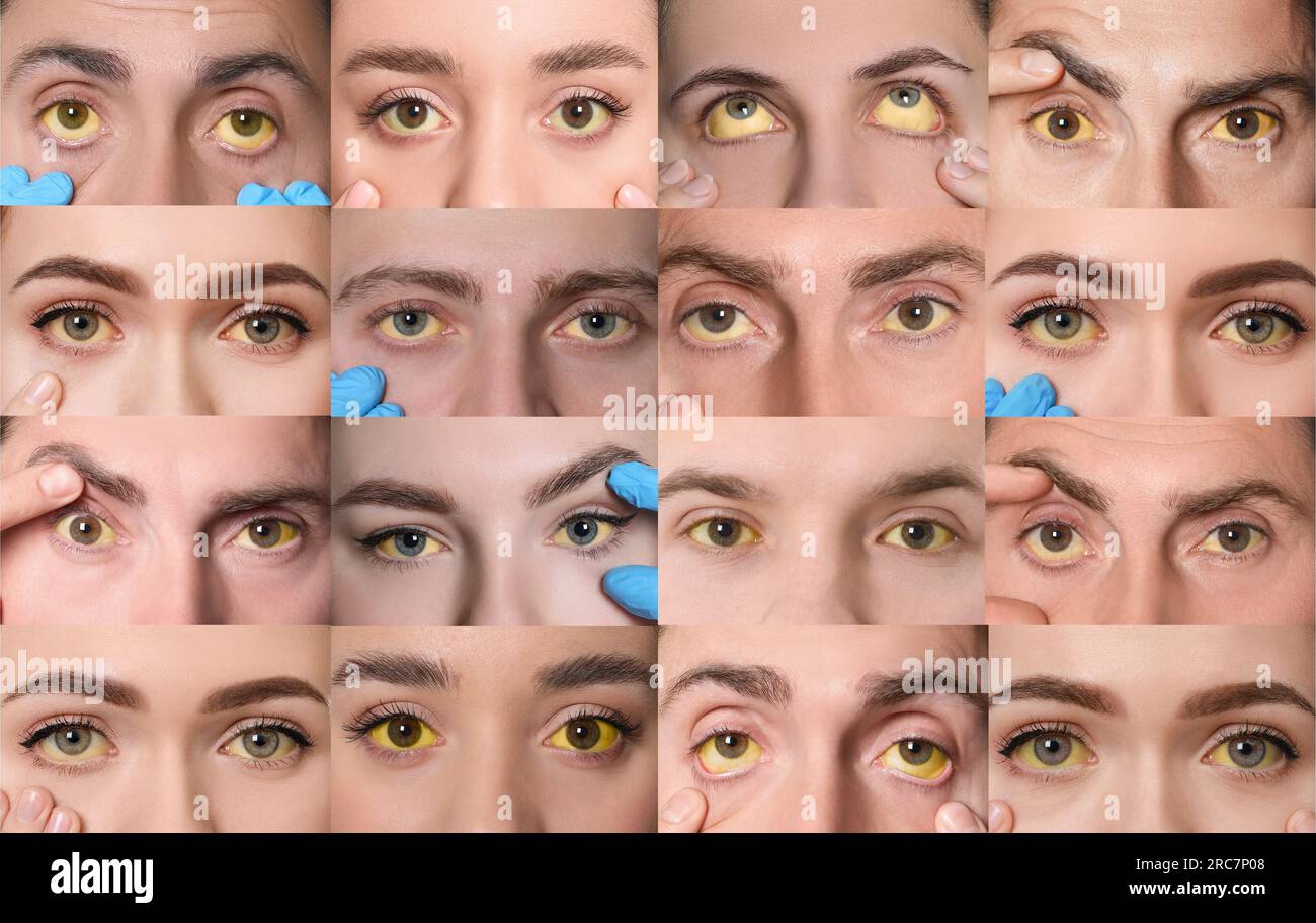 Yellowing of eyes as symptom of hepatitis. Collage with photos of