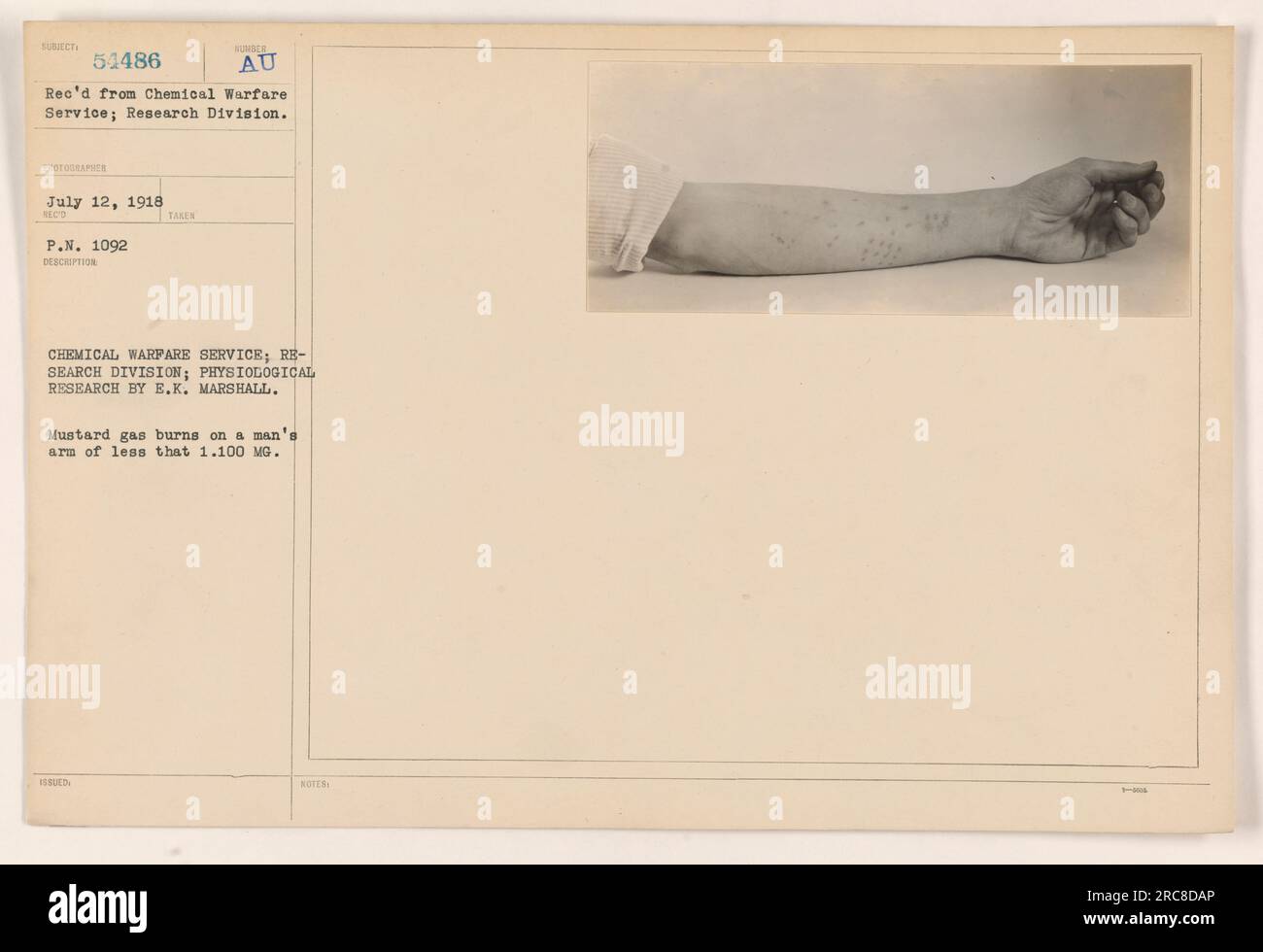 Mustard gas burns on a man's arm, displaying the effects of chemical