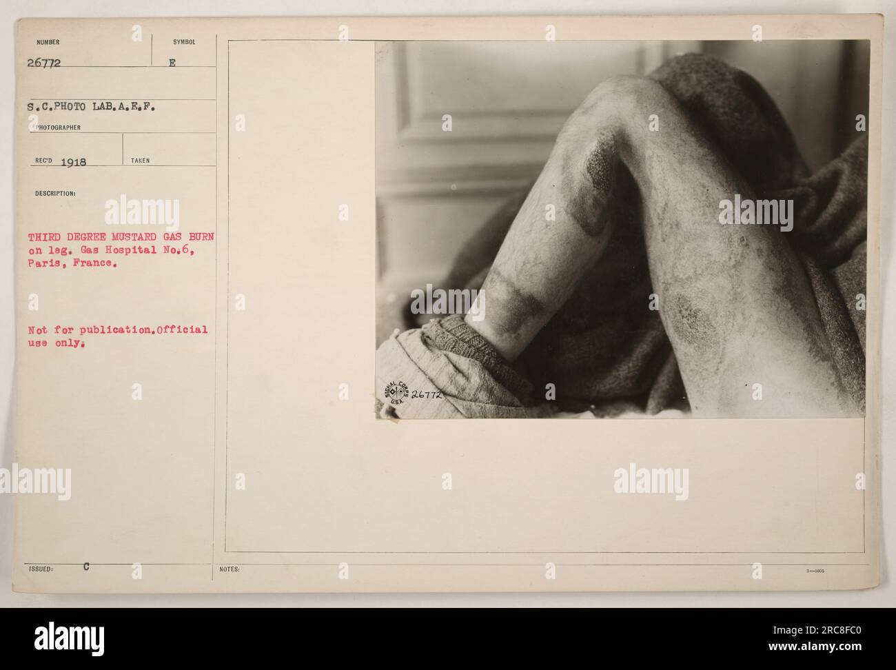 Soldier with mustard gas burn on leg at Gas Hospital No. 6 in Paris