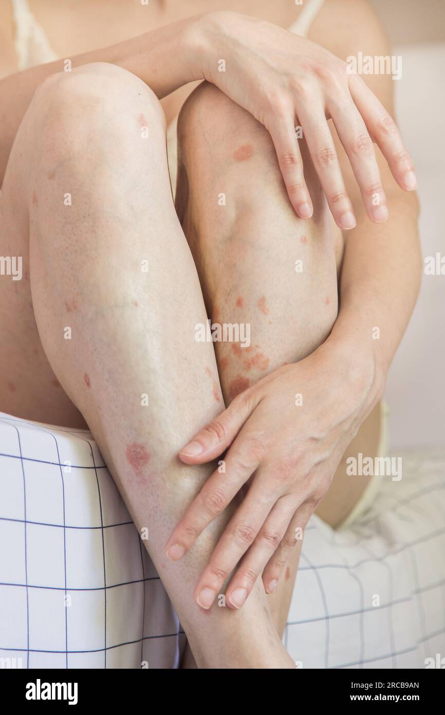 Close up of a person holding a leg.Body detail of Caucasian woman showing acceptance despite having skin problems.Concept of inclusion and self esteem Stock Photo
