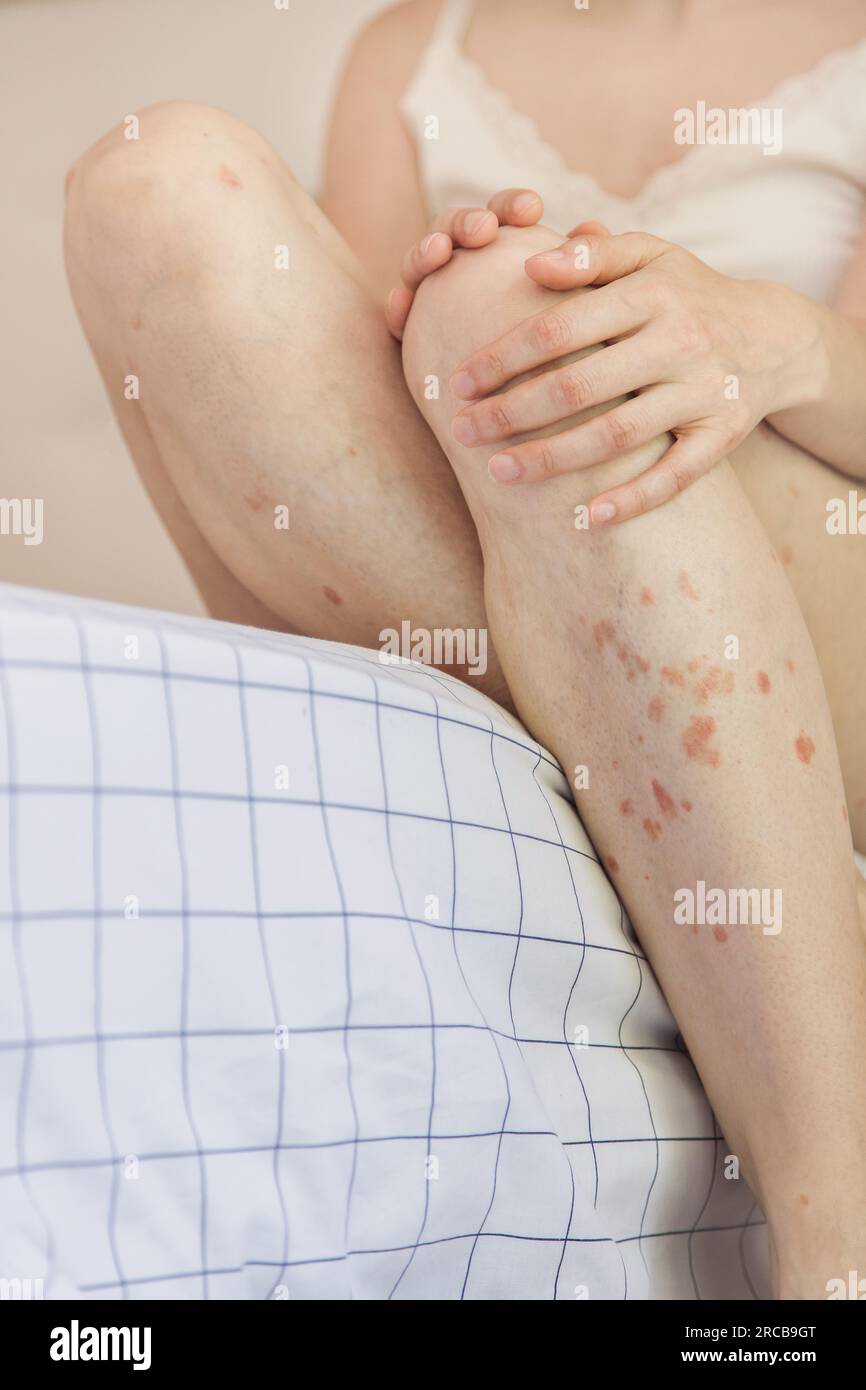 Close up of a person holding a leg.Body detail of Caucasian woman showing acceptance despite having skin problems.Concept of inclusion and self esteem Stock Photo
