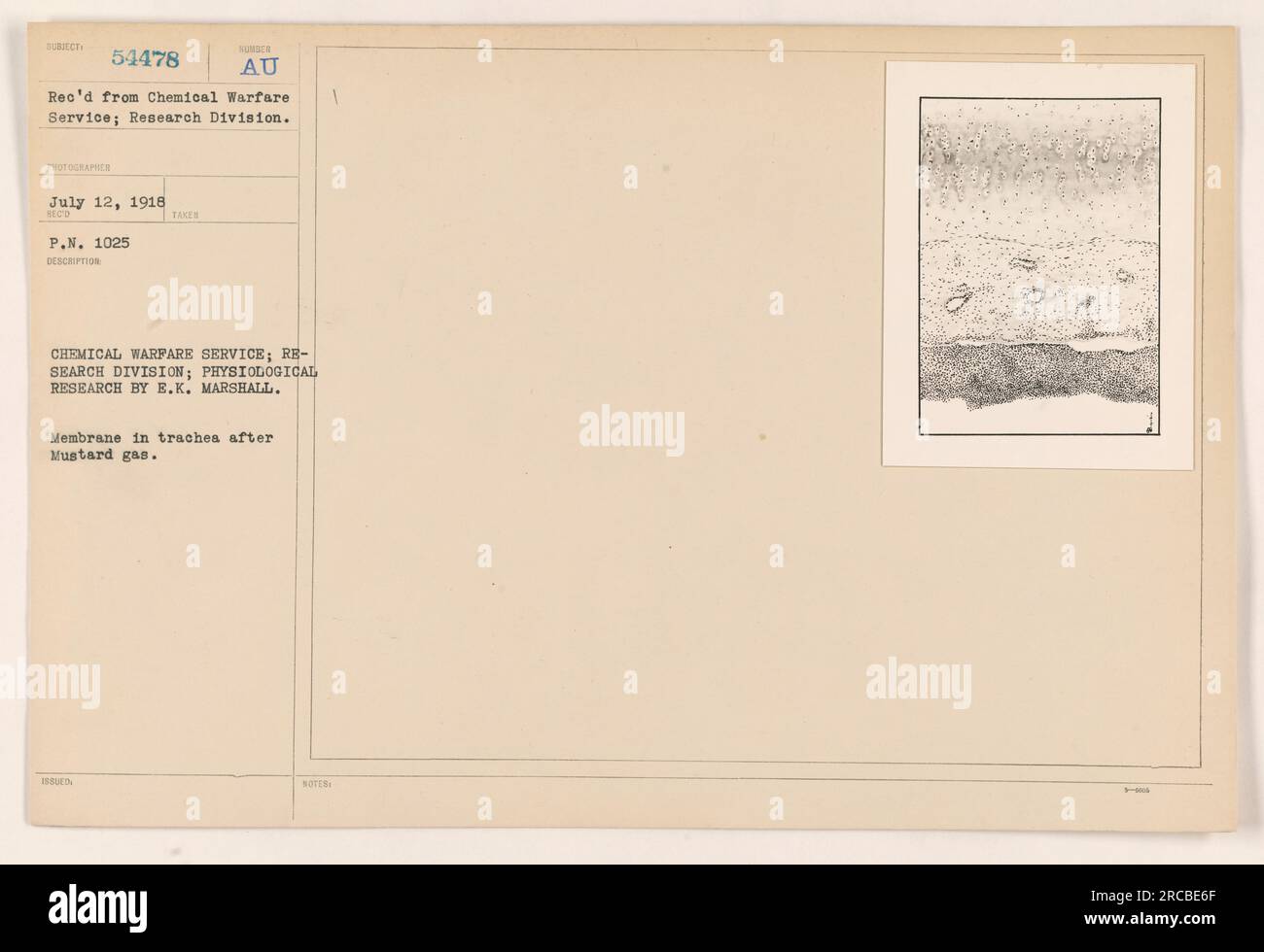 Photograph showing the effects of Mustard gas on the trachea's membrane