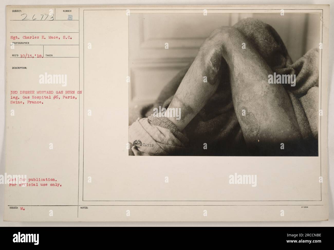 Image captures the leg of Sgt. Charles E. Mace with a severe 3rd degree mustard gas burn during