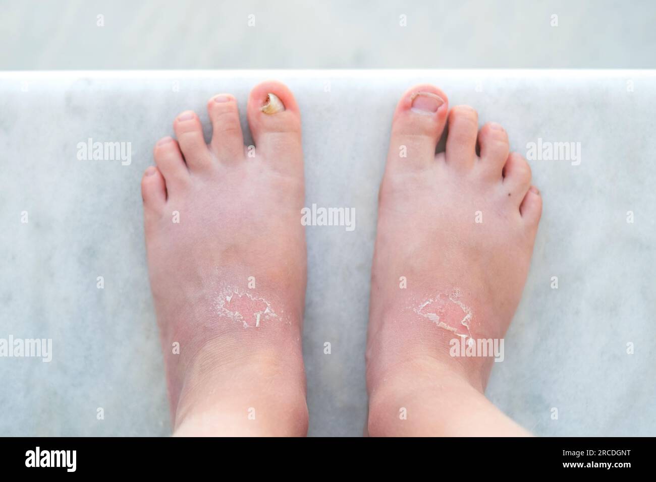 Close up sunburn peeling on the kid legs. top view. The concept of