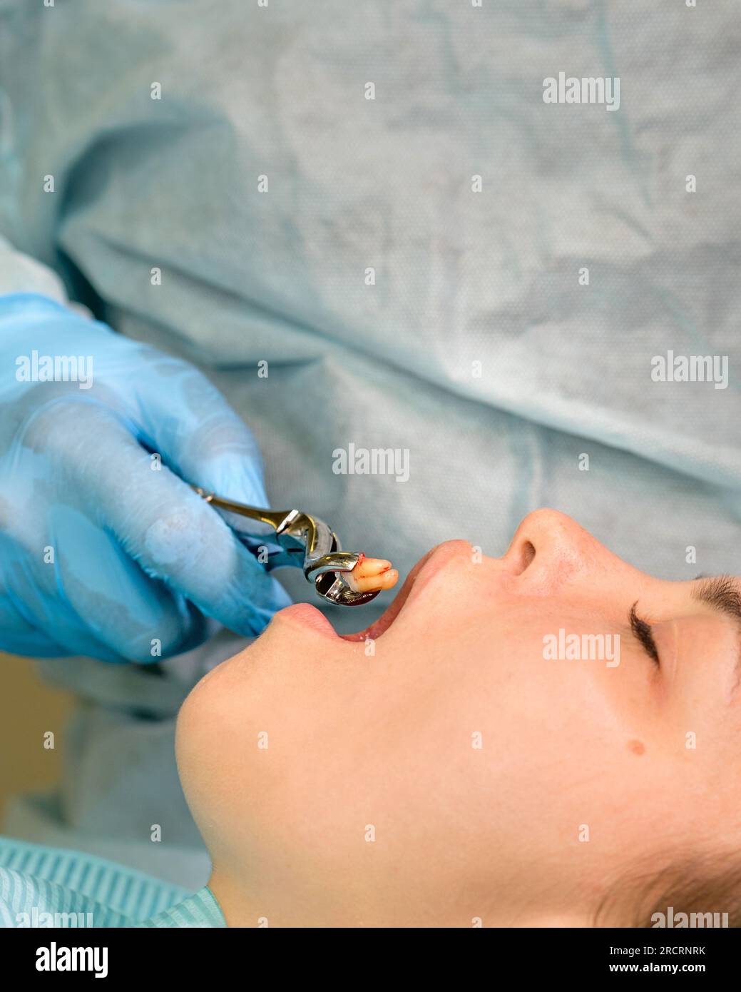 Hand of dentist surgeon holds in forceps a freshly removed wisdom tooth