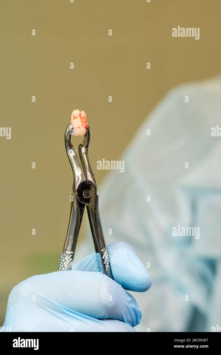 Hand of dentist surgeon holds in forceps a freshly removed wisdom tooth