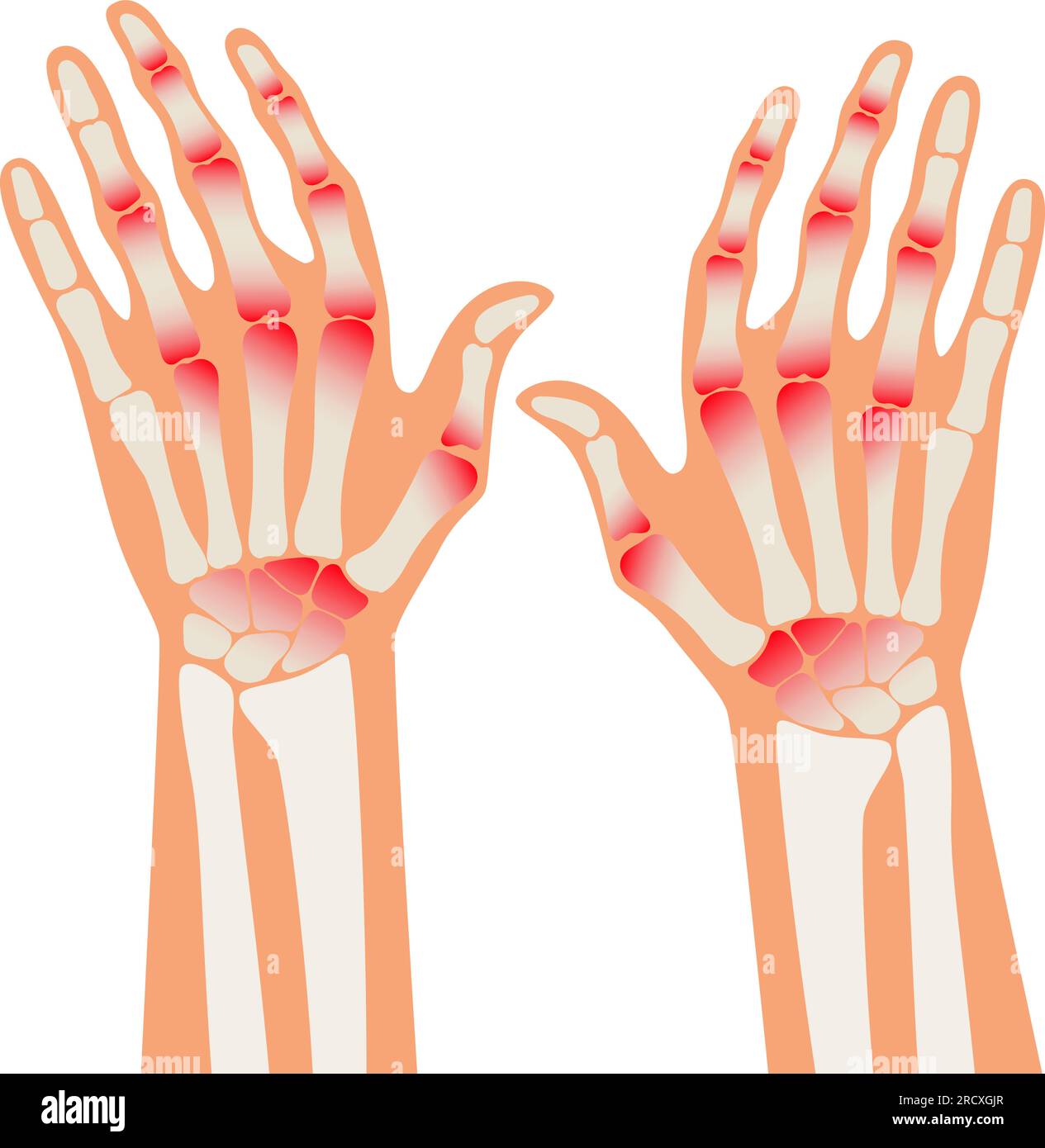 Rheumatoid Arthritis hands. Pain in the human body. Arthritis, bone