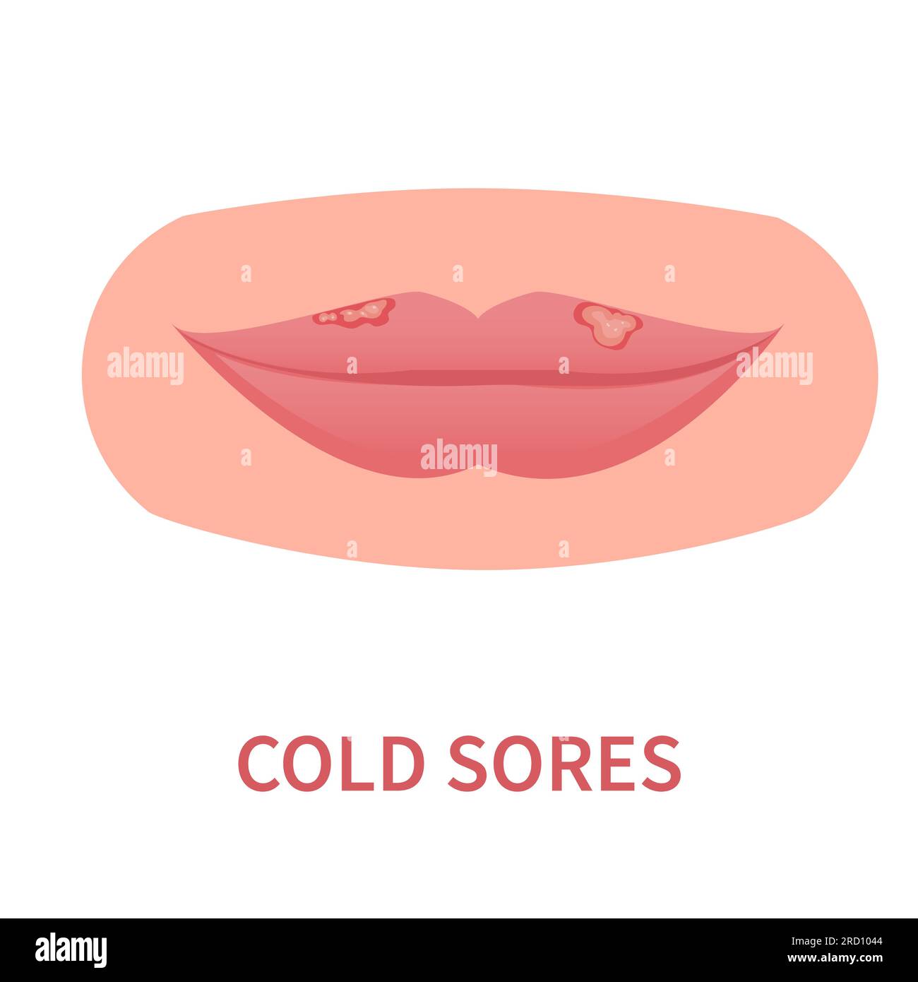 Cold sores outbreak. Herpes Simplex Virus on lips. Oral viral infection