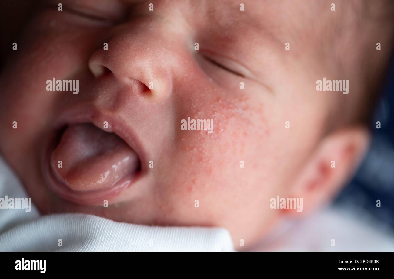 Pimples on the face of a newborn. Baby's adaptation to the environment