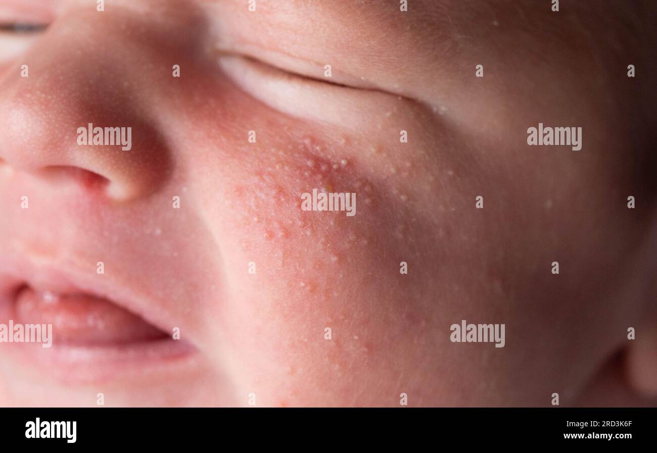 Allergic pimples in a newborn on the face. Pathogenesis, acne of