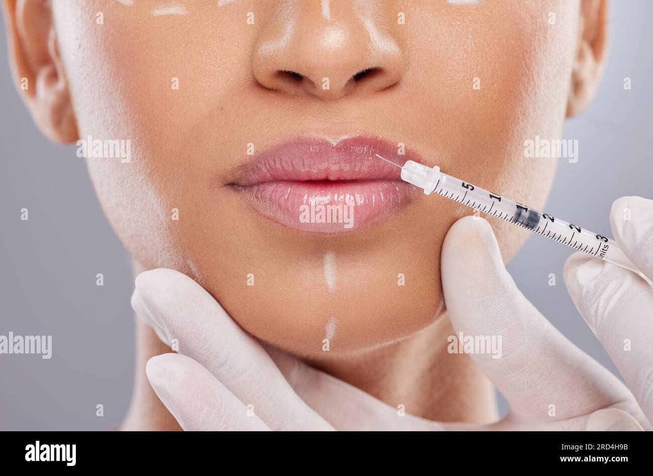 Closeup, lip filler and botox with woman and injection for plastic ...