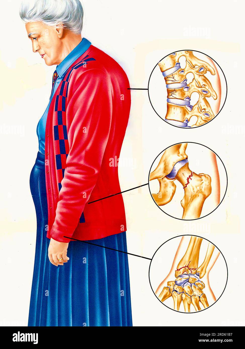 Common osteoporosis fractures, illustration Stock Photo Alamy