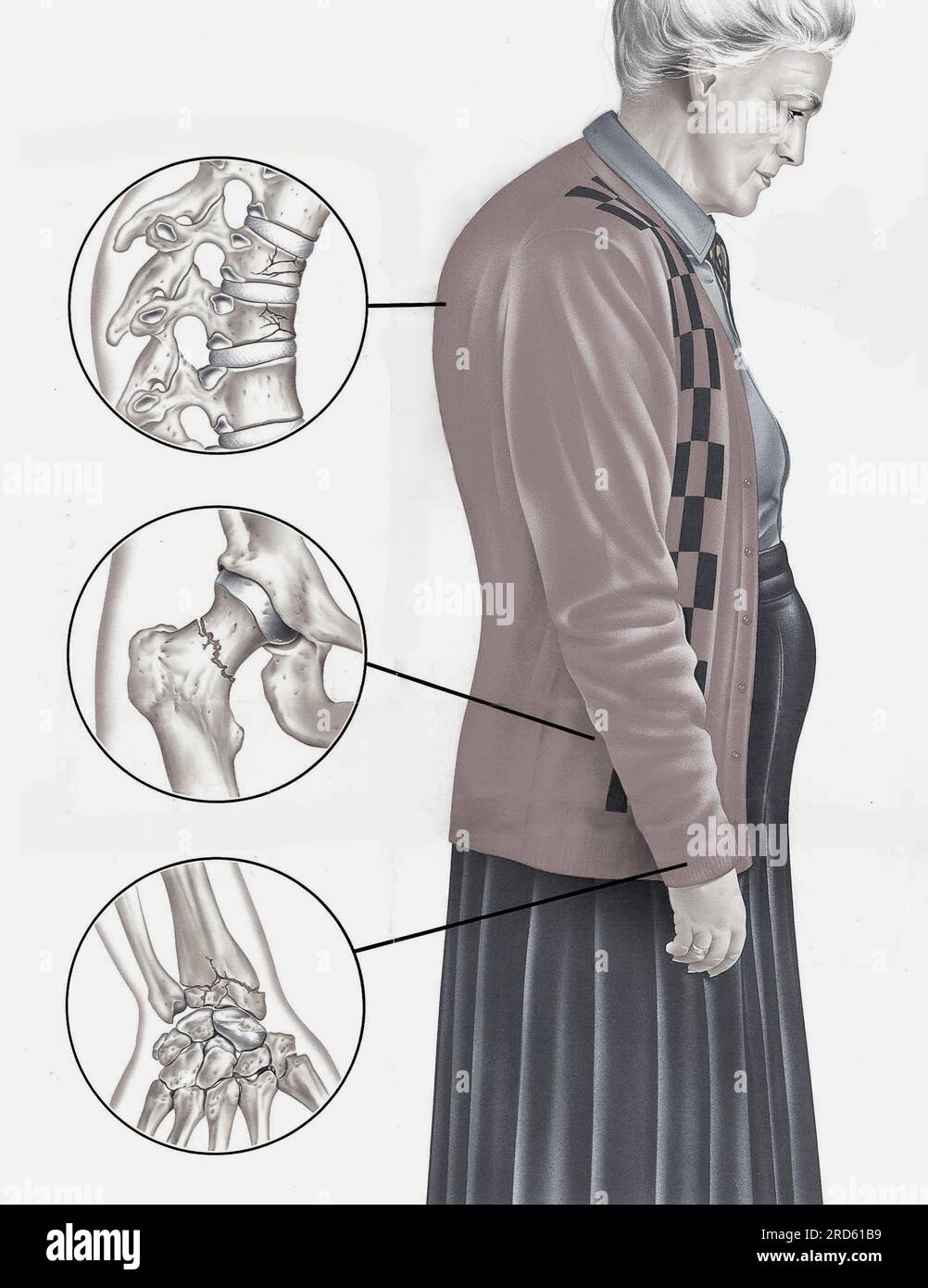 Common osteoporosis fractures, illustration Stock Photo Alamy