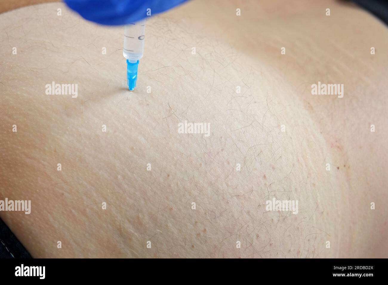 Needle injecting into the muscle. Nurse doing a trigger point injection ...