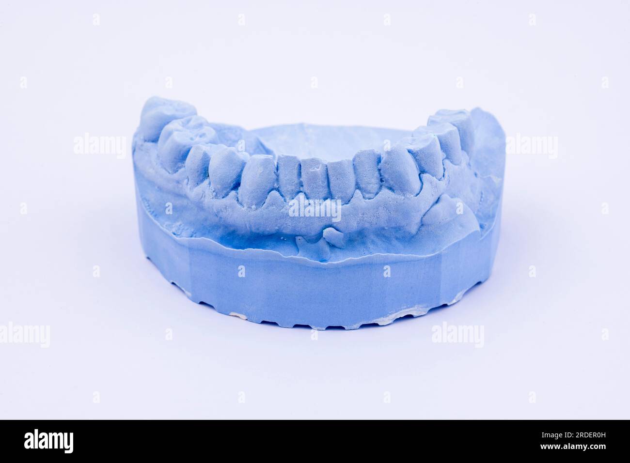 Denture impression of an upper jaw for dentures, dentist, dental
