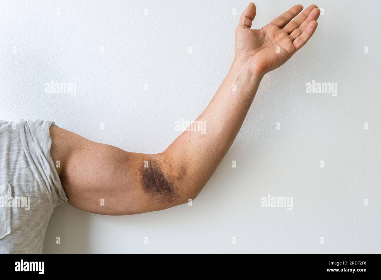 injury ligament arm bruise Stock Photo Alamy