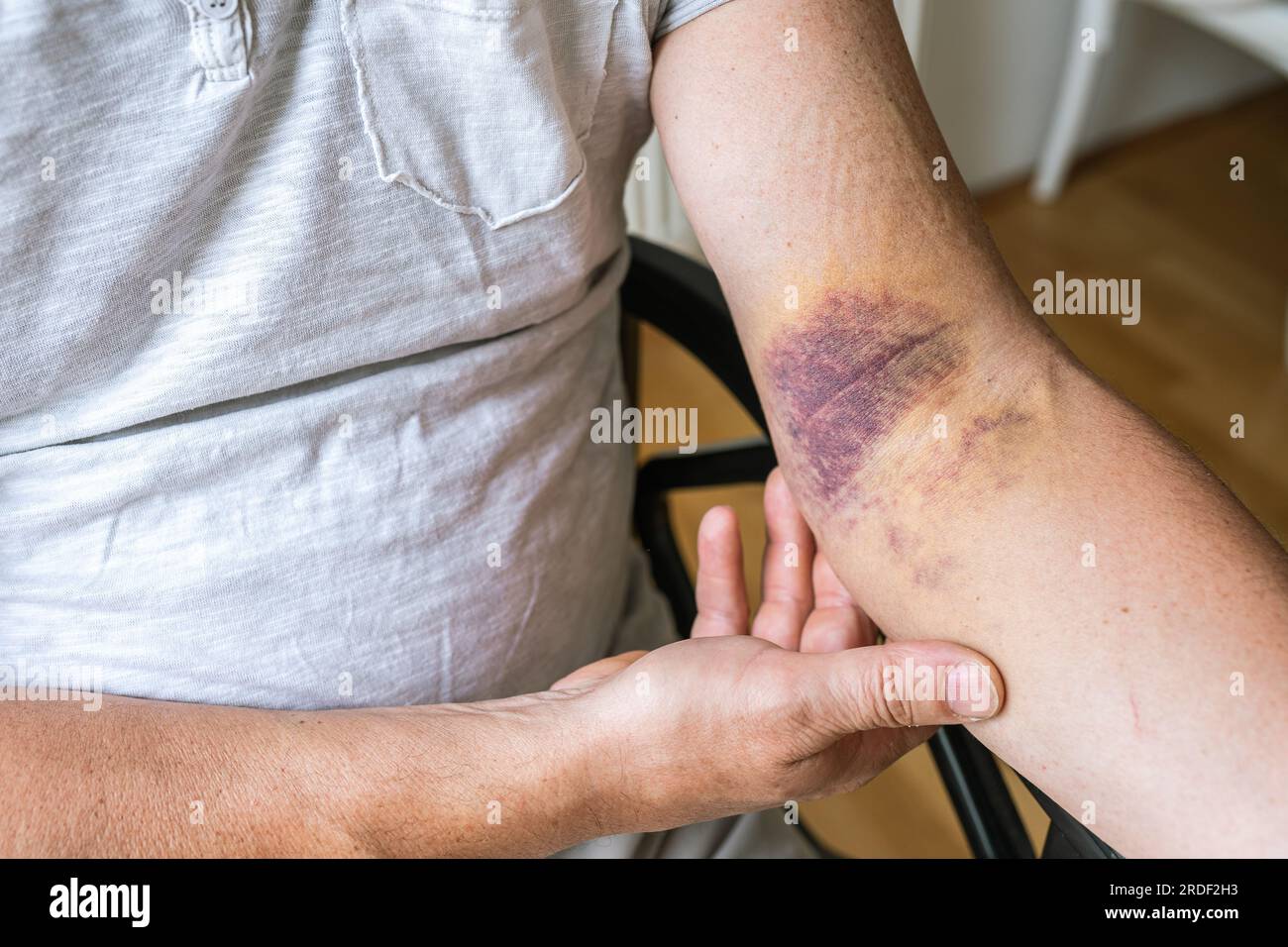 injury ligament arm bruise Stock Photo - Alamy