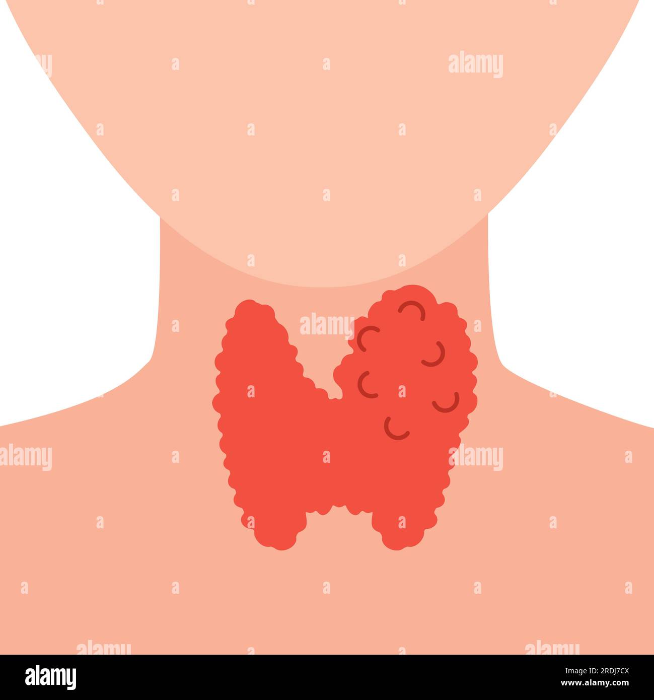 Enlarged thyroid gland, illustration Stock Photo Alamy