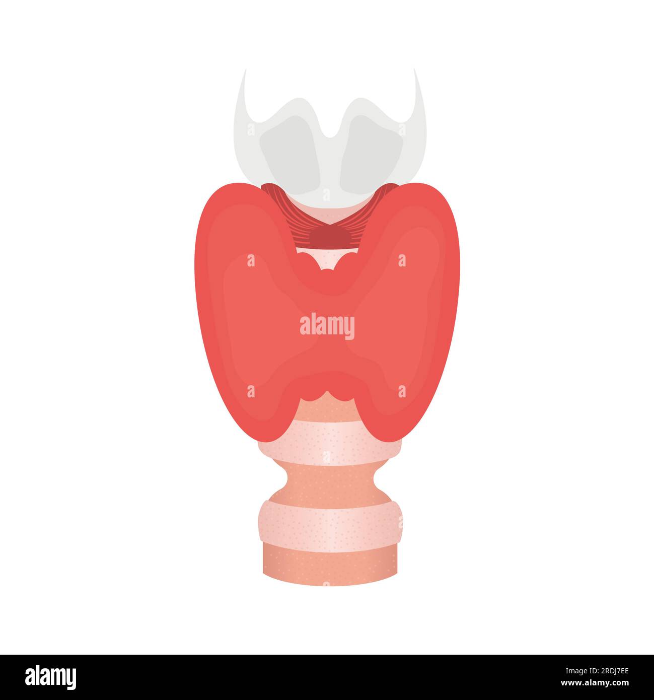 Tracheal stenosis, illustration Stock Photo